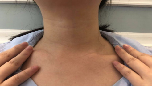 女生脖子上一道颈纹等于增龄10岁!颈纹怎么淡化?