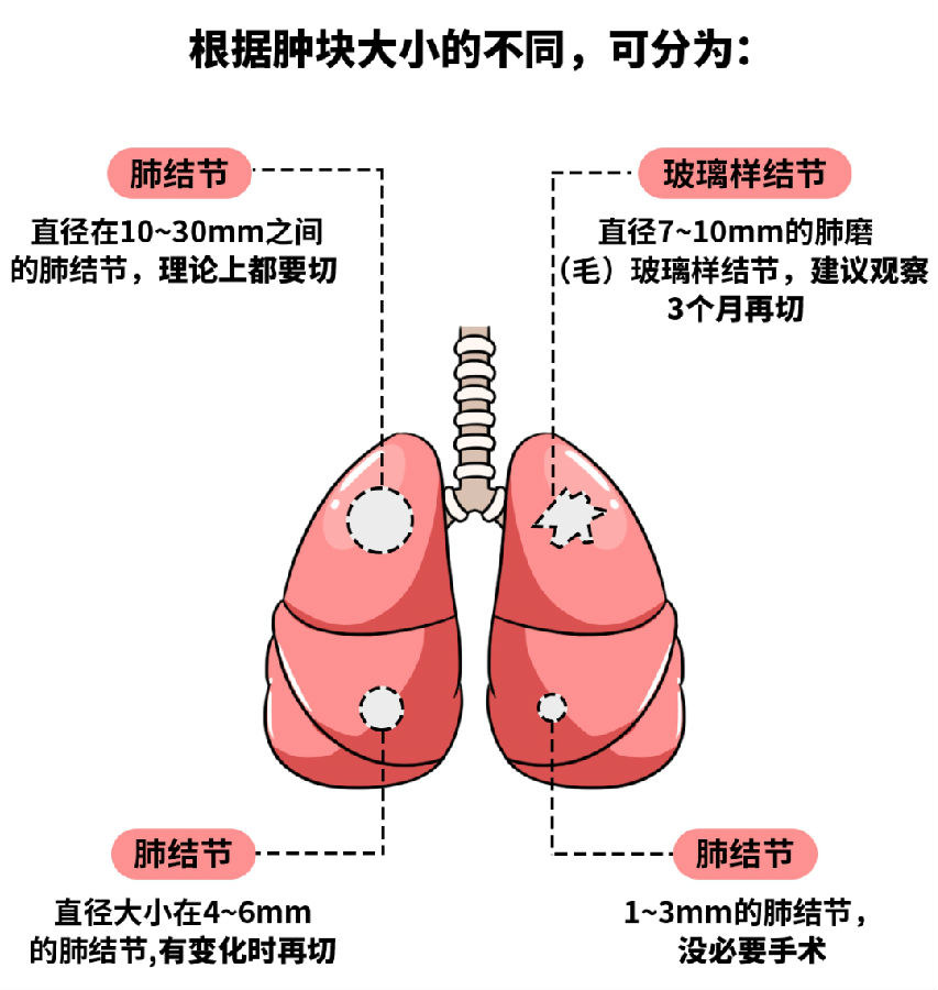 肺结节大小图片