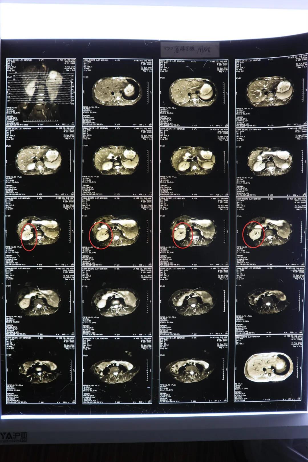 17年前的一场手术后肾消失了