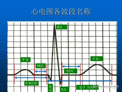 t波高尖的心电图特征图片