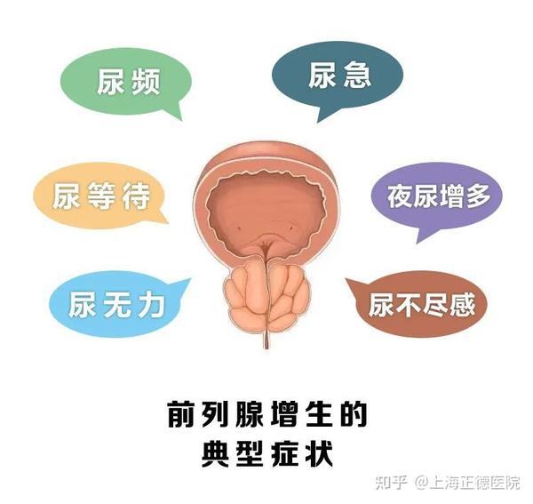 来自我判断一下,你的前列腺是否增生 - 知乎