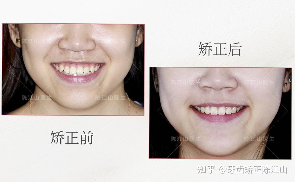 牙齿矫正丨笑线是什么？如何获得？ - 知乎