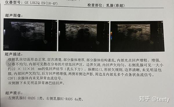 乳腺肿块，bi Rads 4a类 知乎