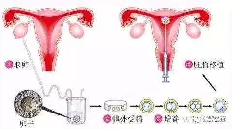 人工助孕方法一次图片