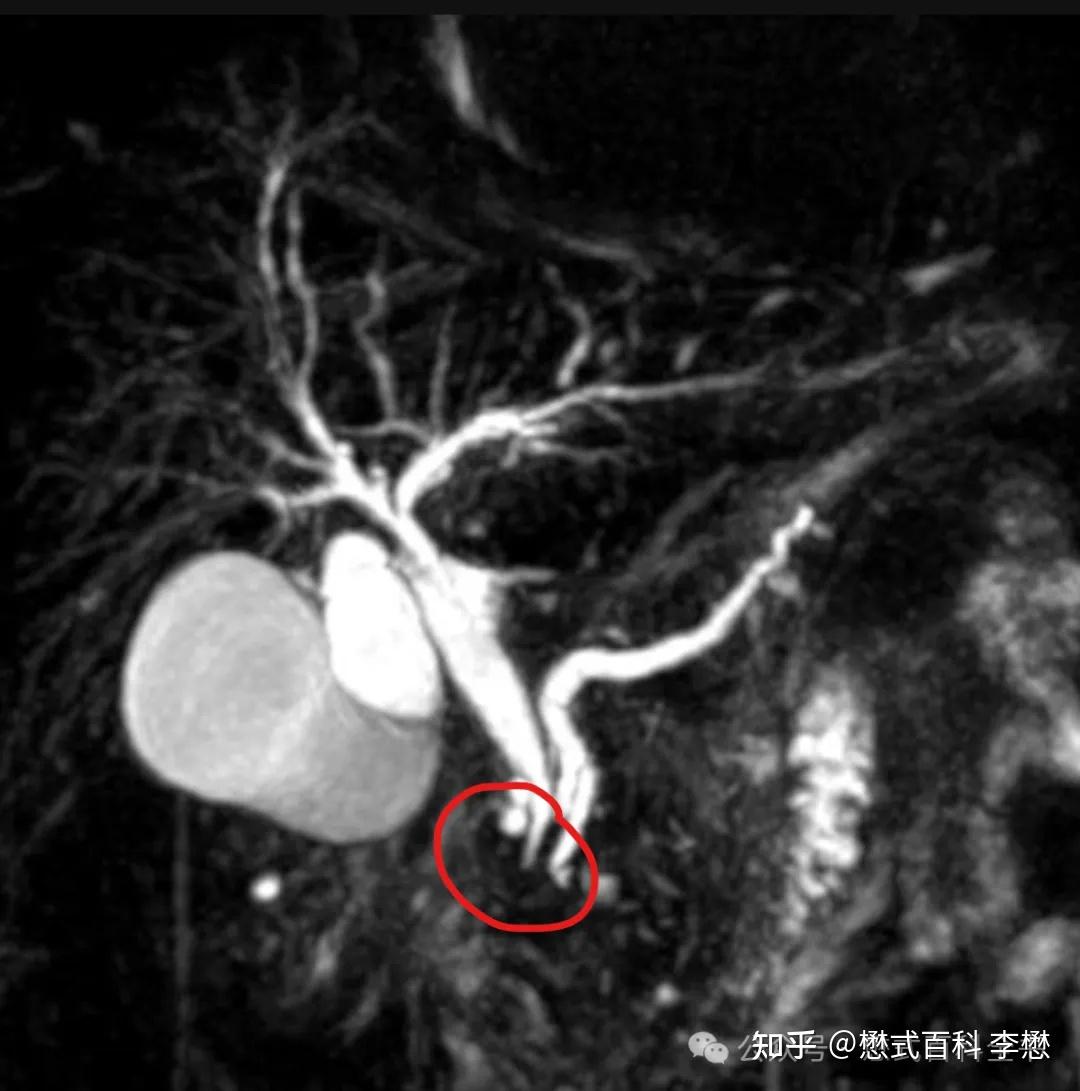 图6:ct明显的双管征图7中,mrcp显示了胆总管和胰管,胰管是明显扩张