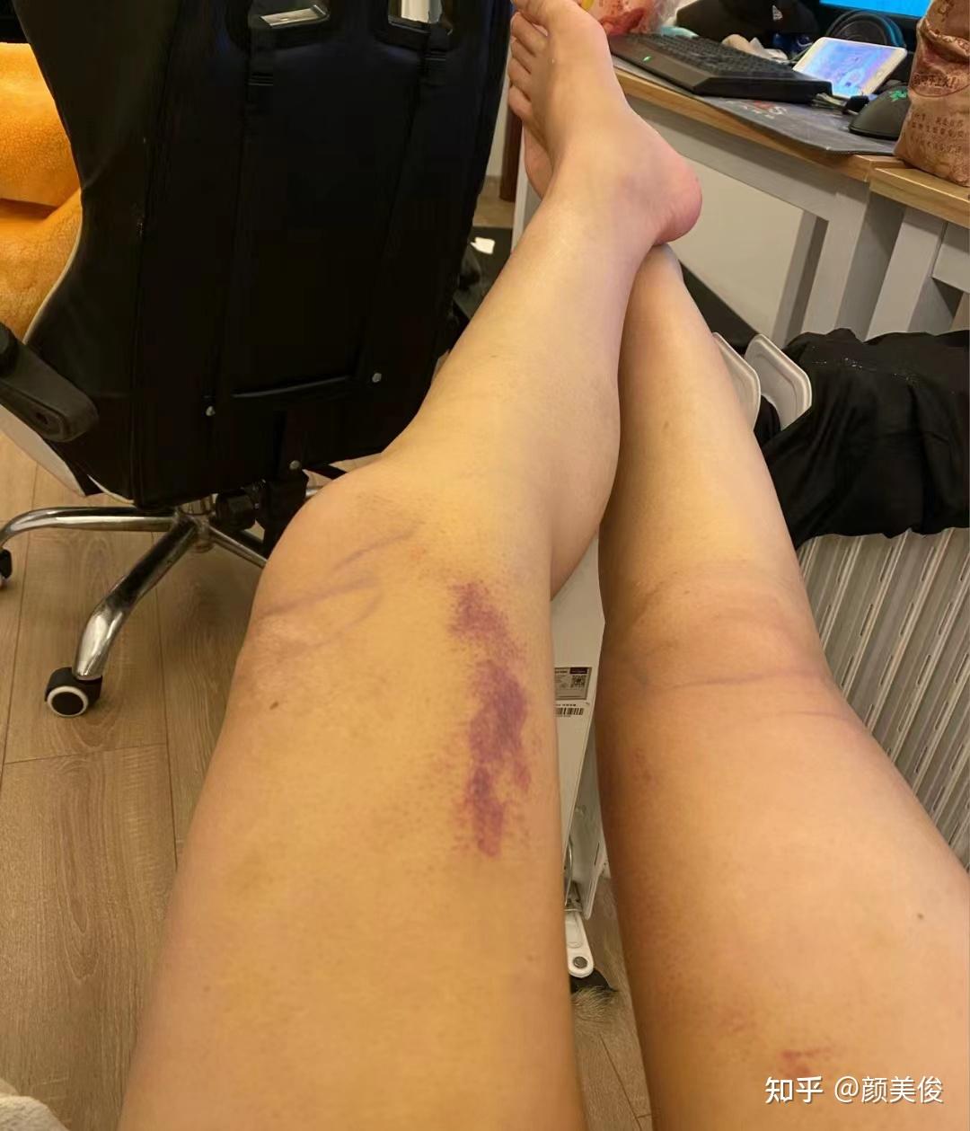 成都大腿环吸案例分享;术后1个月恢复照片