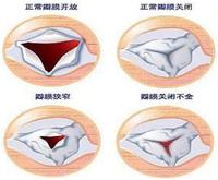 重度二尖瓣反流怎么治疗呢? - 知乎