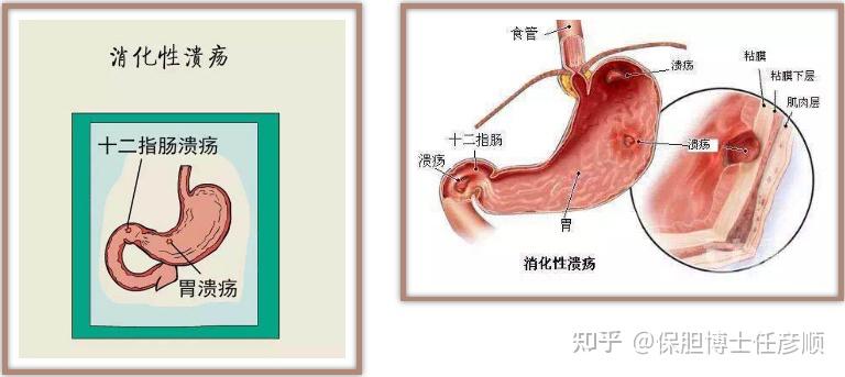 3,膽囊切除與消化性潰瘍膽囊切除與膽汁反流性胃炎4,某些肝臟疾病膽囊