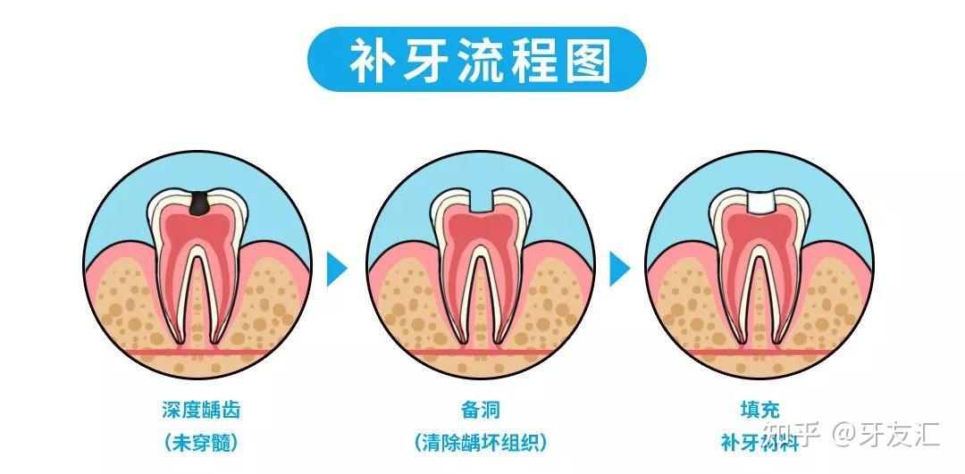 深龋不疼可以只补牙吗? - 知乎