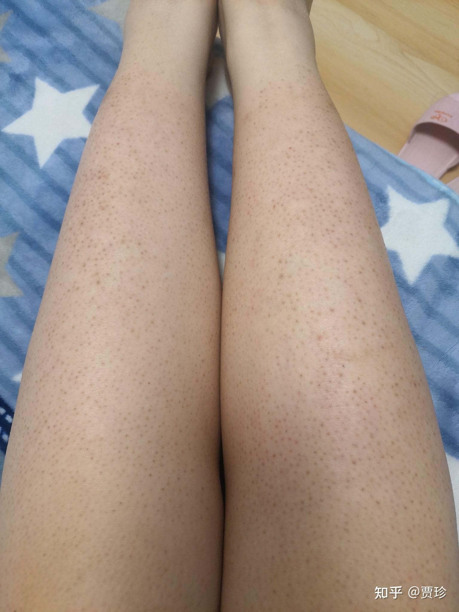 脱毛仪用后变成鸡皮肤(鸡皮肤可以使用脱毛仪吗)