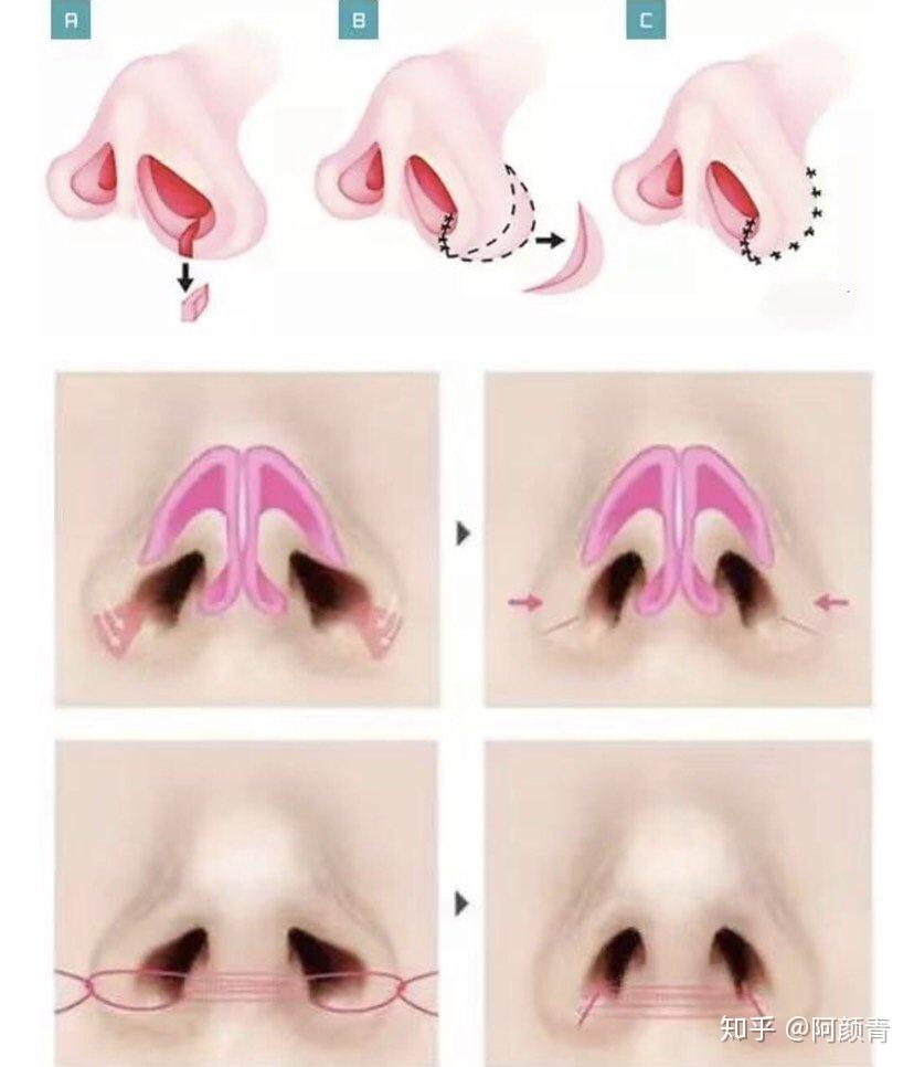 鼻翼缩小整形手术(鼻孔缩小术)其实这种鼻部美容手术是由于那些鼻翼过
