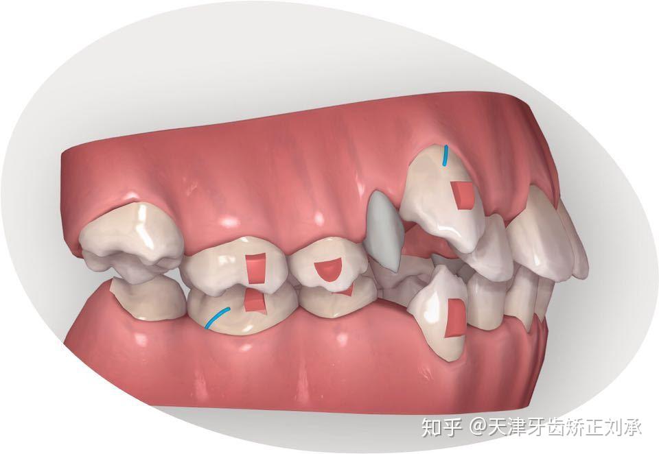 天津牙齿矫正正畸中的二类牵引有什么用基础篇