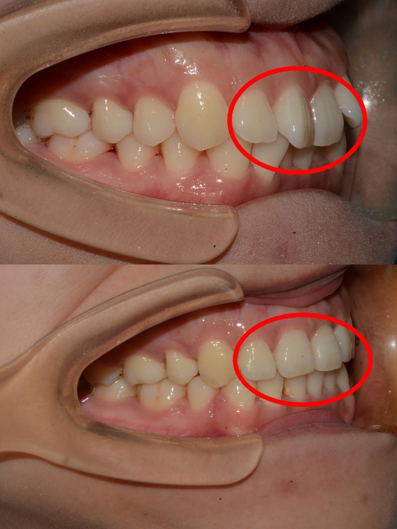重庆牙齿矫正牙列不齐凸面型拔牙矫正
