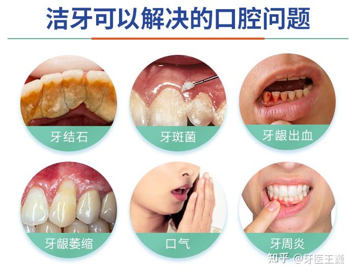 洁牙对牙齿有伤害吗出现这三种症状正常吗牙科专家这样说