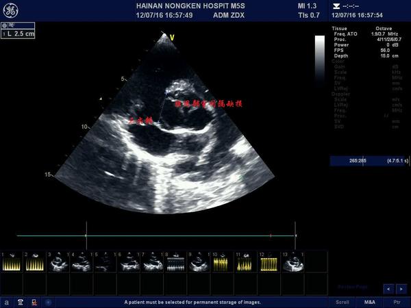 室间隔缺损超声图解图片