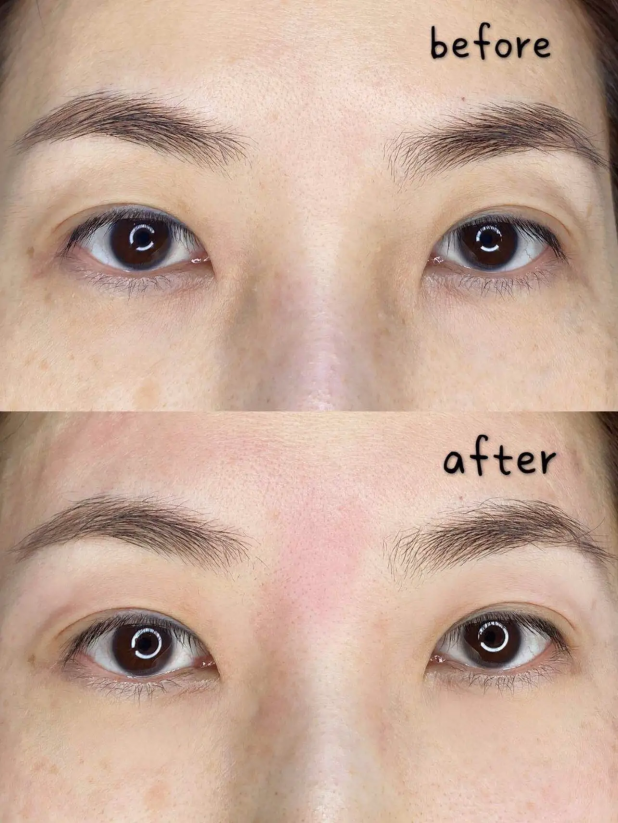 欧洲之星fotona4d多少钱欧洲之星效果如何做欧洲之星值得吗