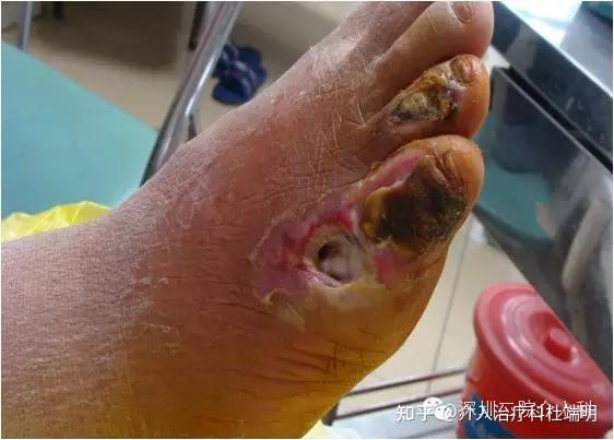 糖尿病足合并下肢动脉硬化闭塞症的血管介入治疗