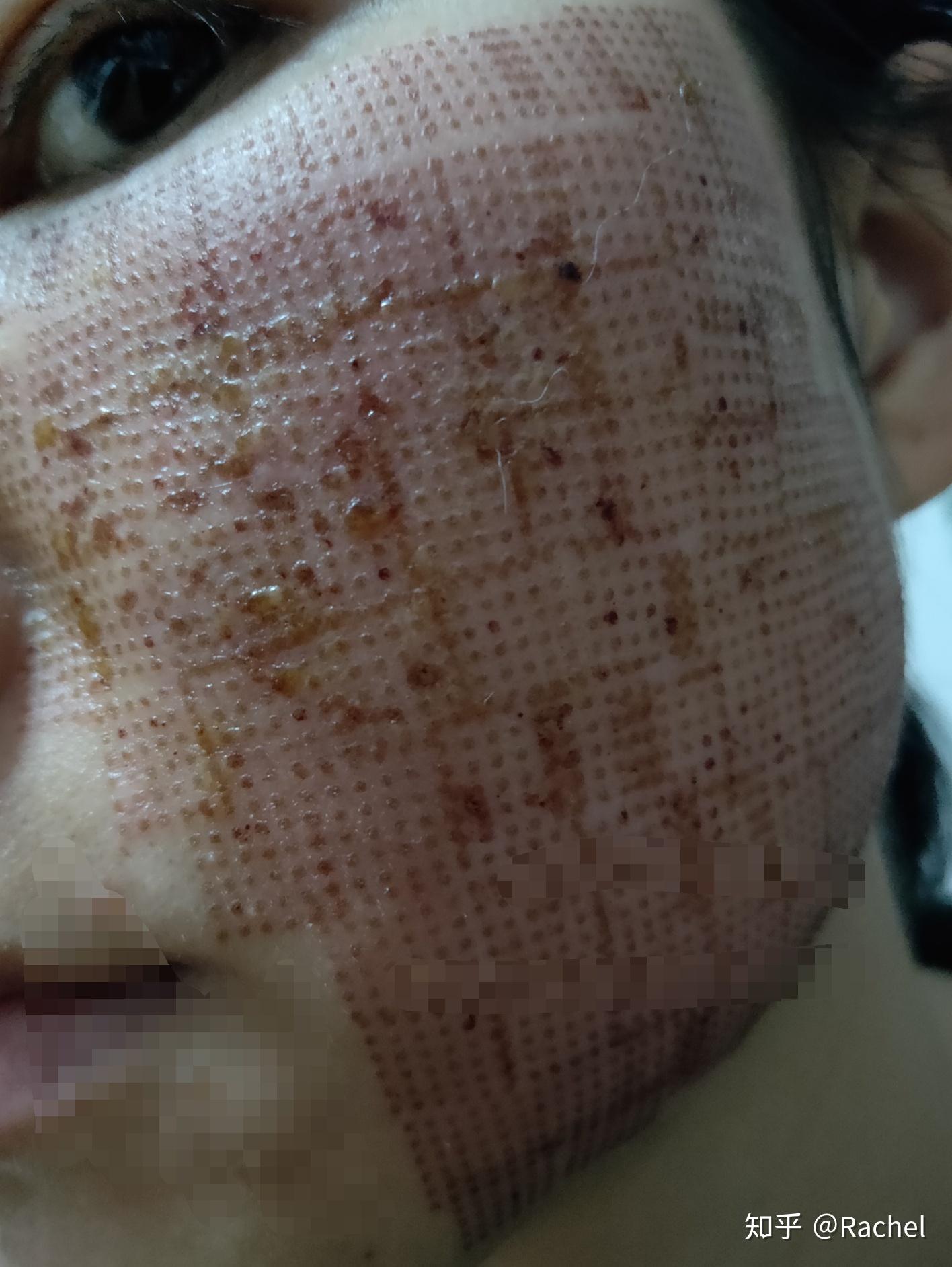 记录一下自己点阵激光的历程