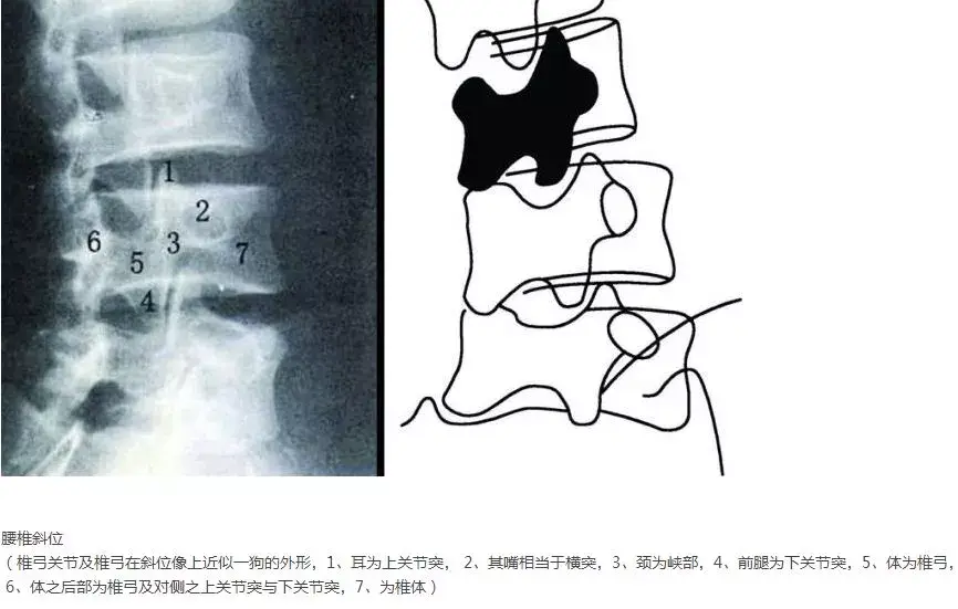 腰椎峡部裂lumbarspondylolysis
