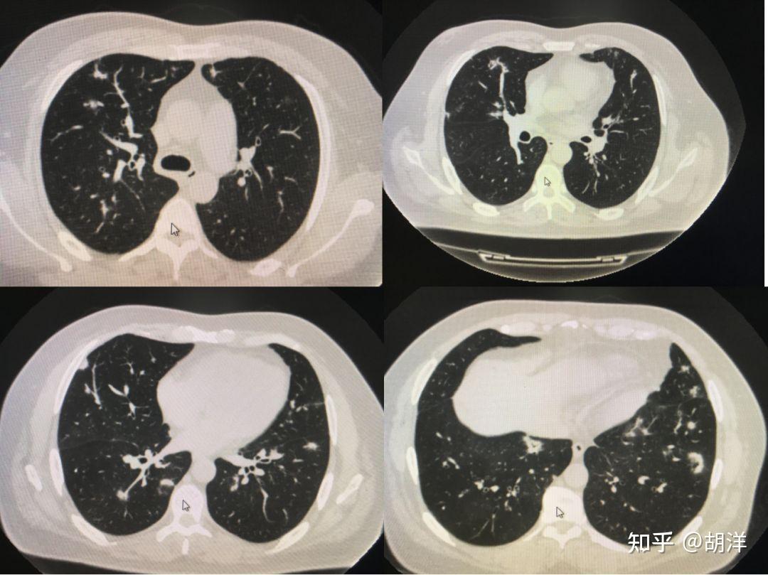 病例130 中央型肺癌(一)-临床医学-医学