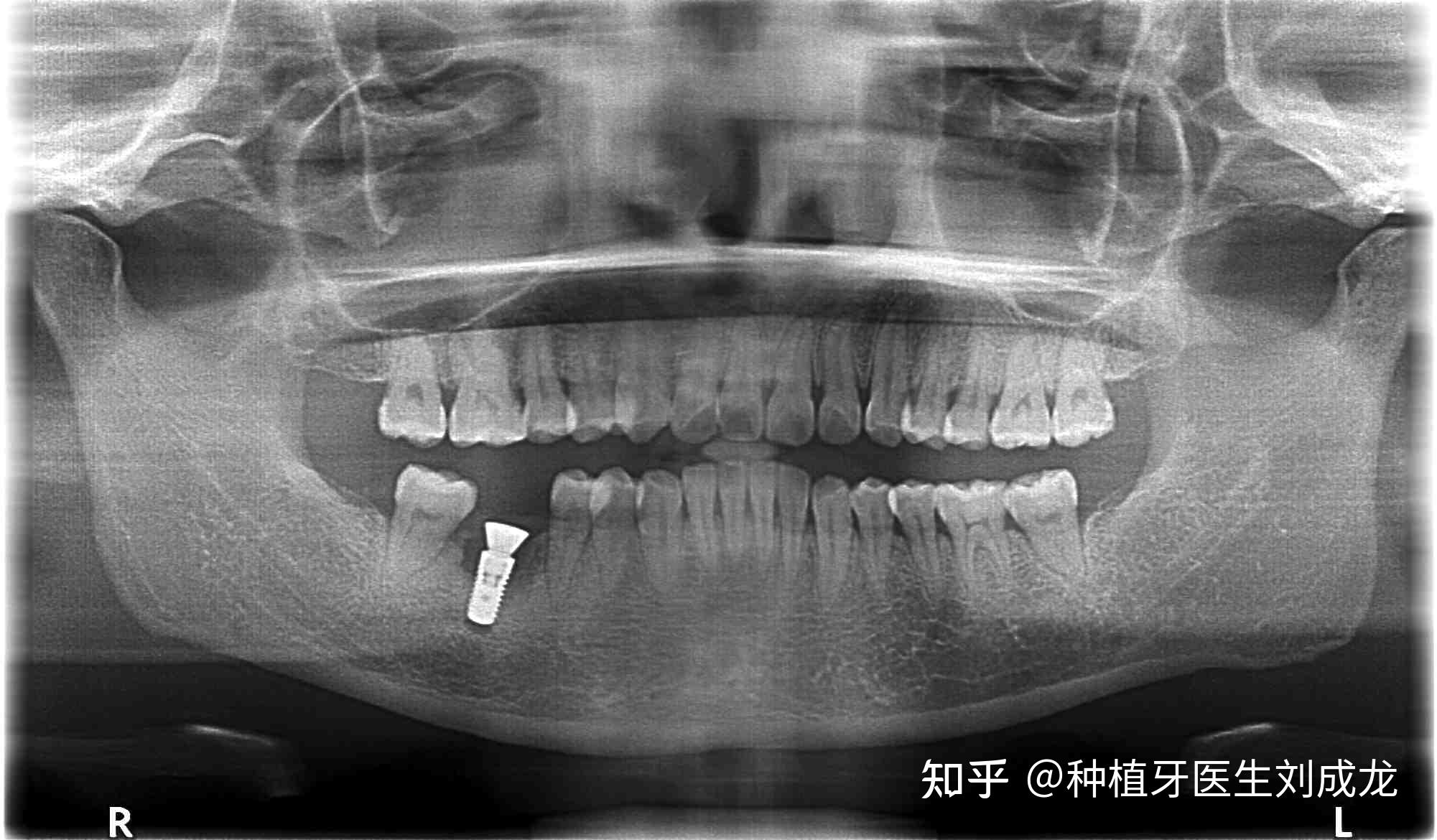 郑州瑞士iti种植牙医生刘成龙41岁女士磨牙区单颗种植案例