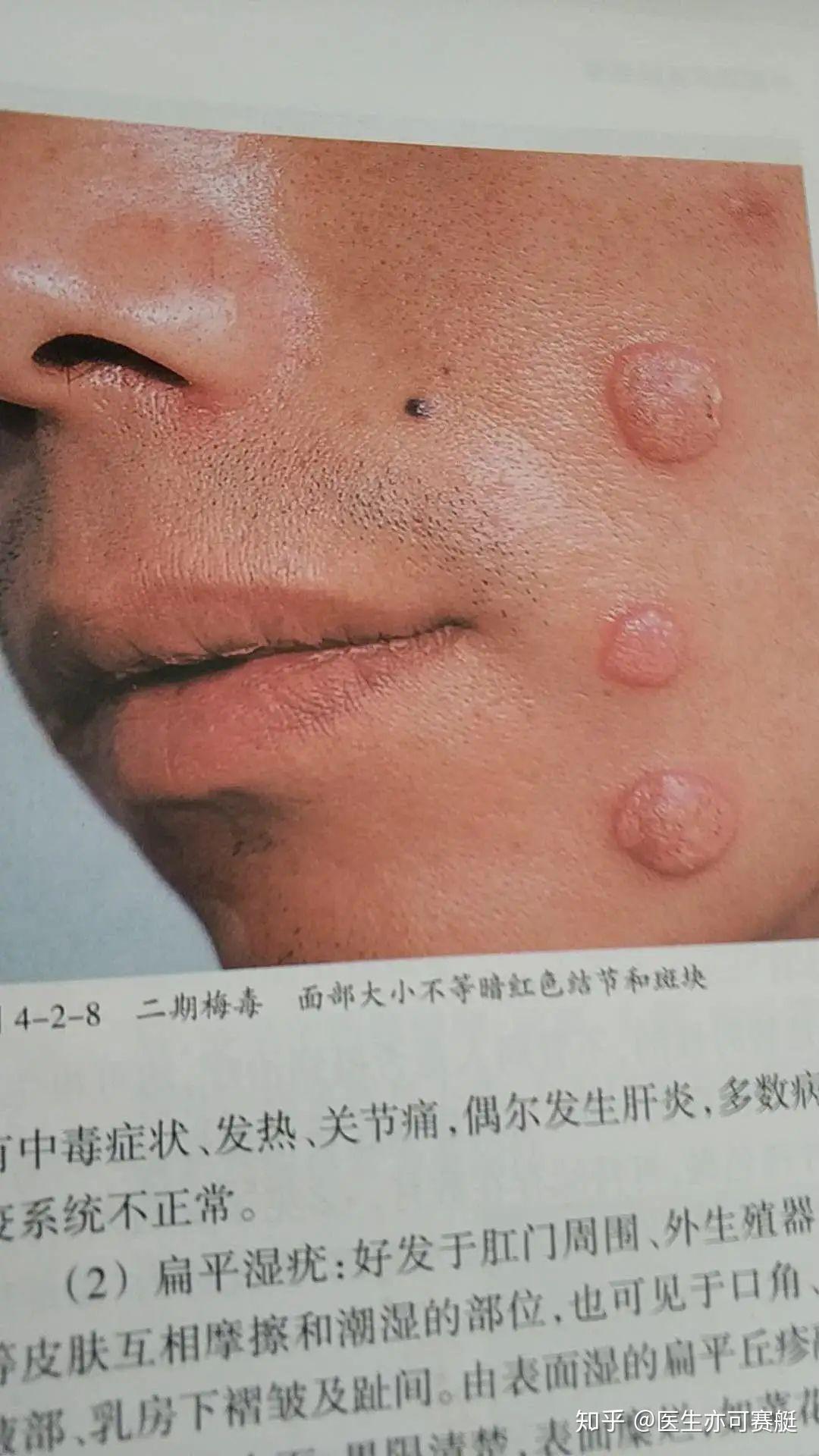 梅毒二期一期梅毒图片
