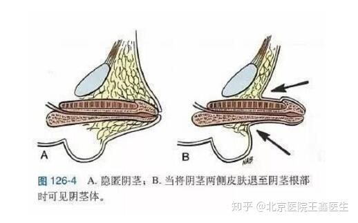 阴茎增大阿拉伯挤奶法和负压吸引法有效果吗?