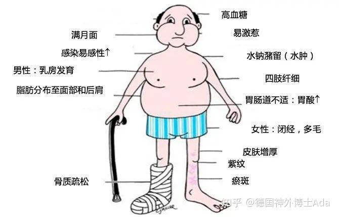 满月脸水牛背健康与美貌皆失库欣病能治愈吗