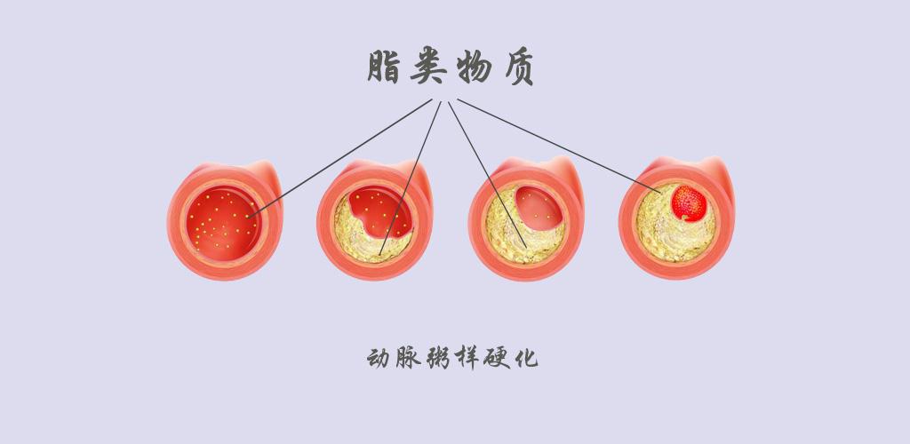 治療動脈粥樣硬化應該吃哪款他汀