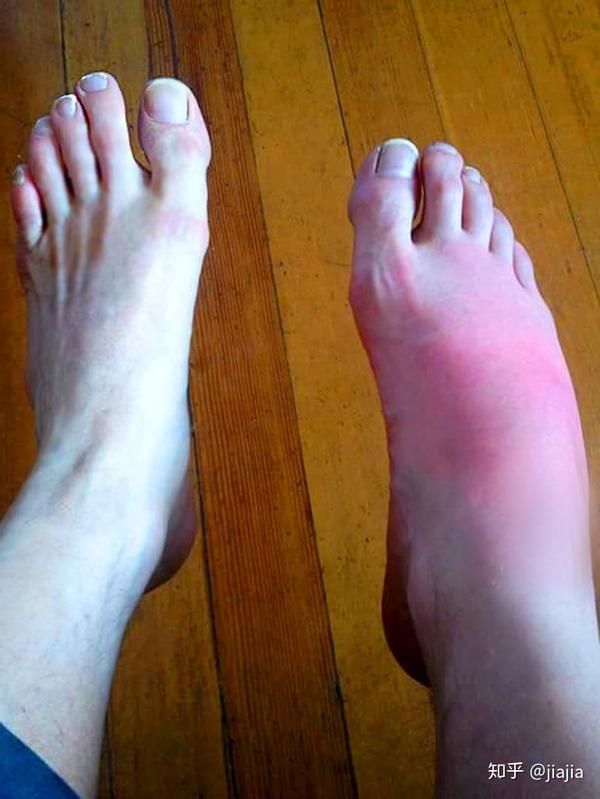 痛风形成原因与危害痛风石让人恐惧石头