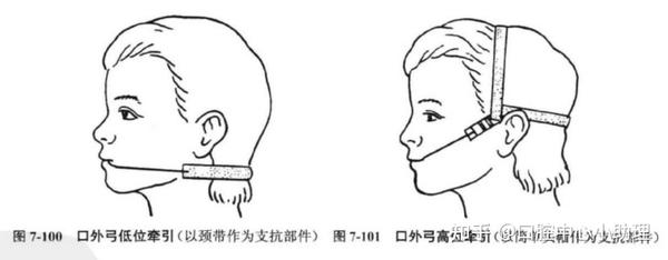推磨牙向后的病例,一定要选择隐形矫正吗? - 知乎