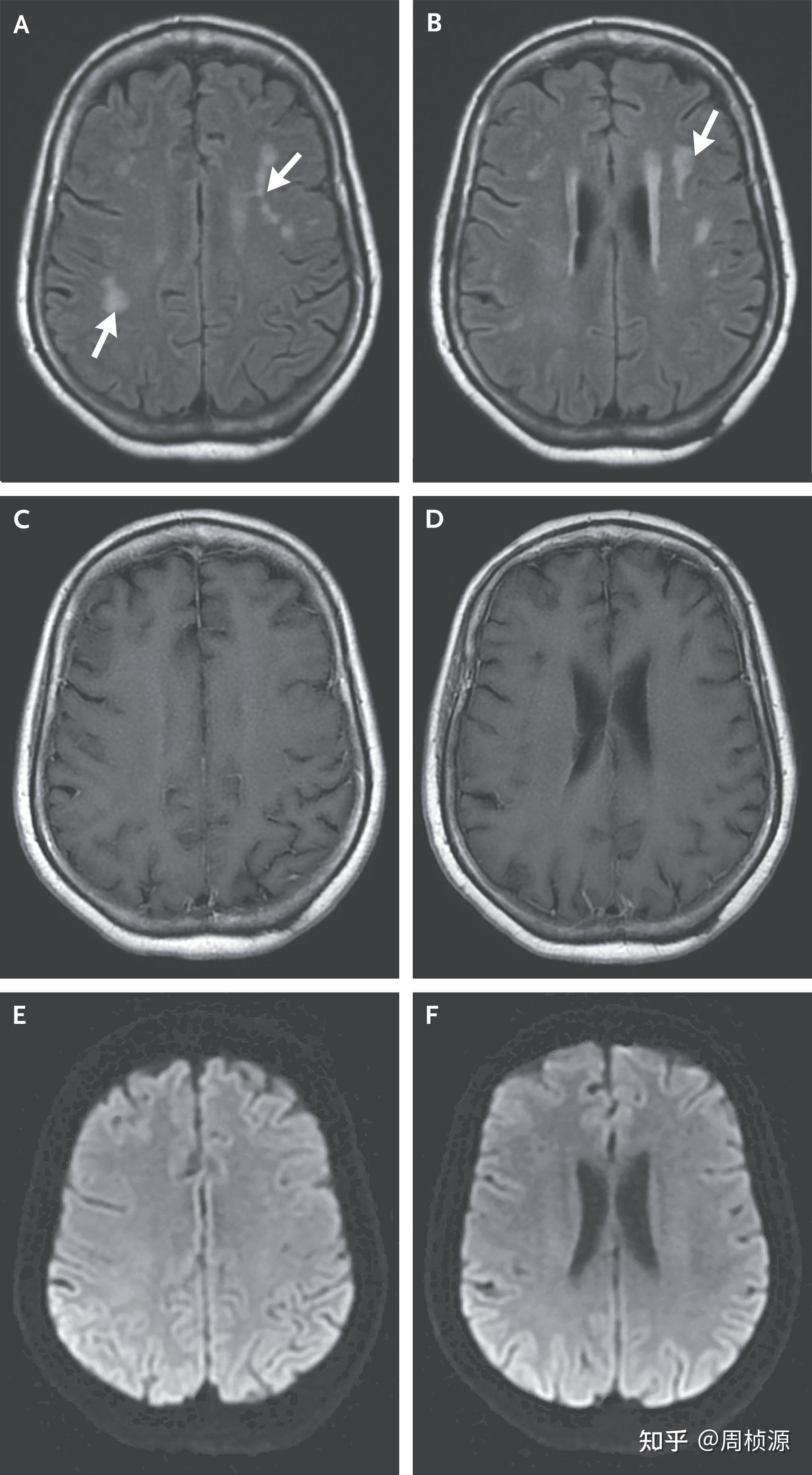 Nejm 2021 Case 24 知乎