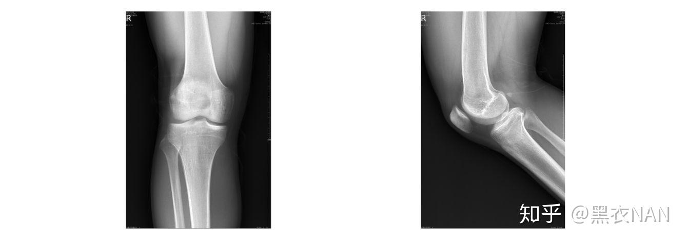 胫骨近端骨骺图片