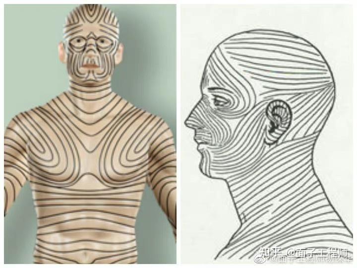 因为皮肤表面具有皮肤张力线,即朗氏线(langer lines).