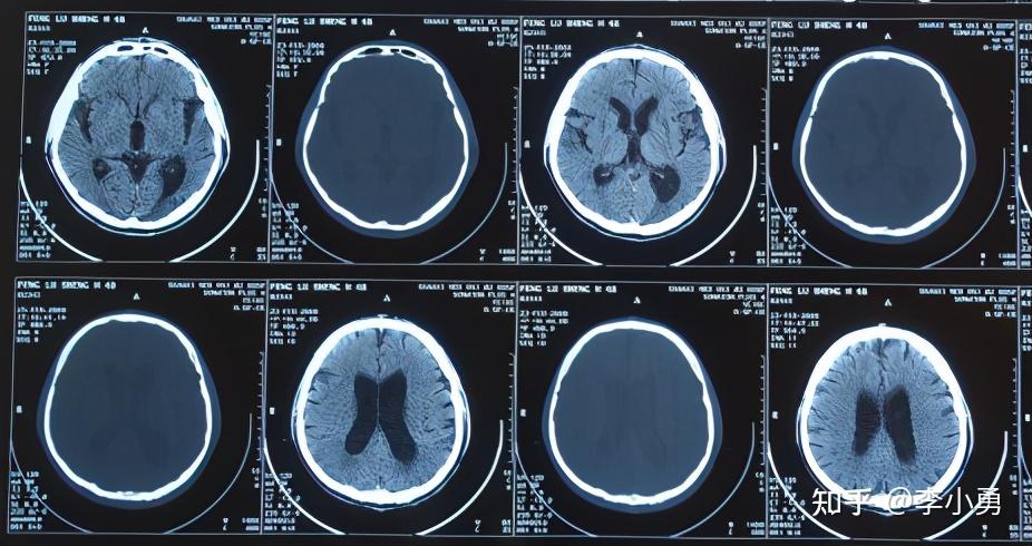 在山西省某三甲医院复查,头颅ct提示"梗阻性脑积水,侧脑室,三脑室增大