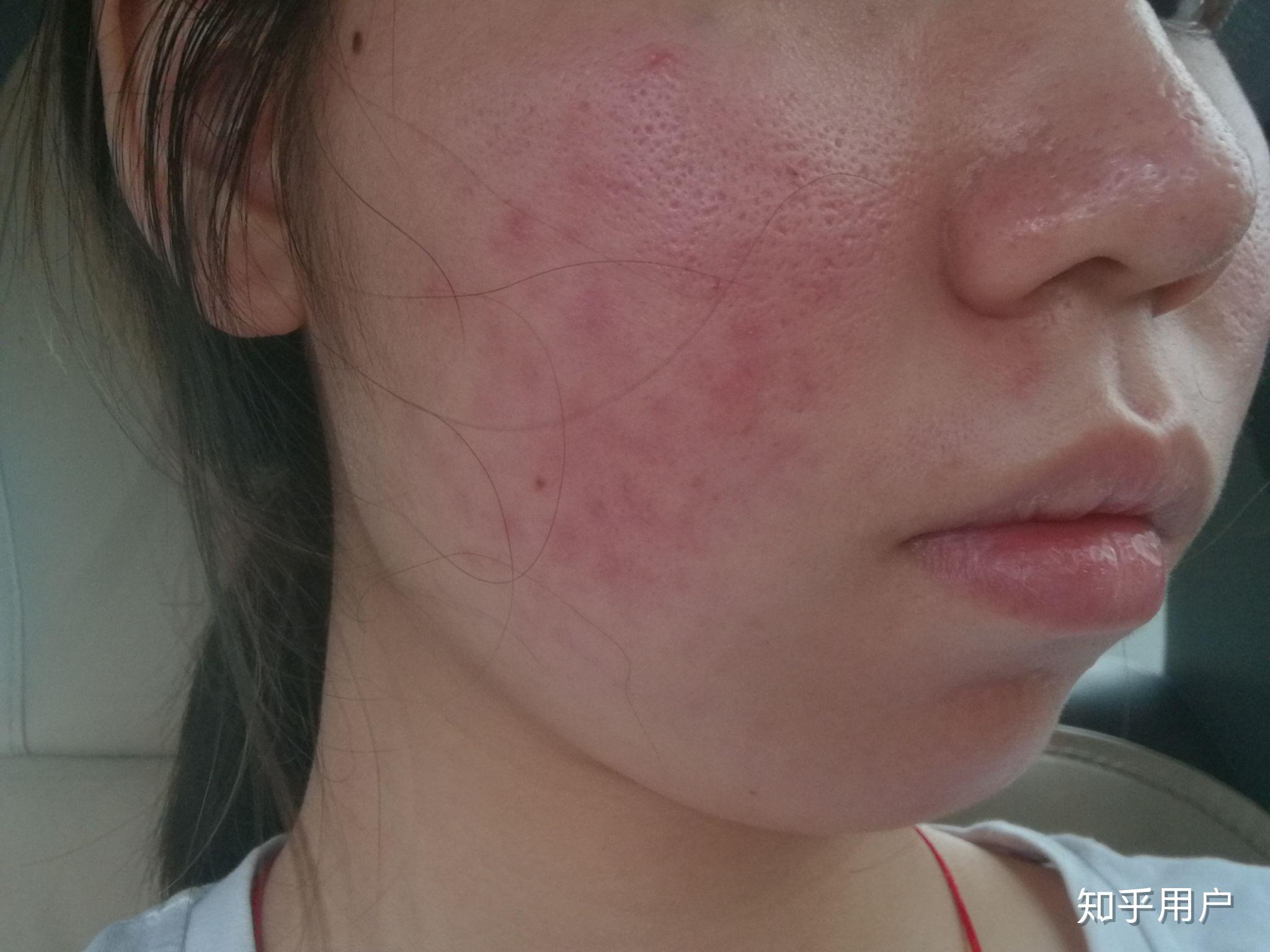 玫瑰痤疮怎么治