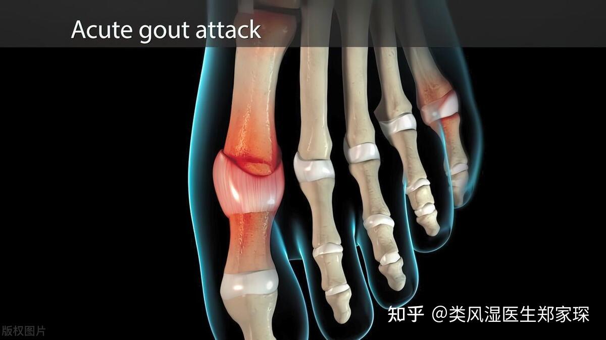 怎样分辨痛风和脚痛？ - 知乎