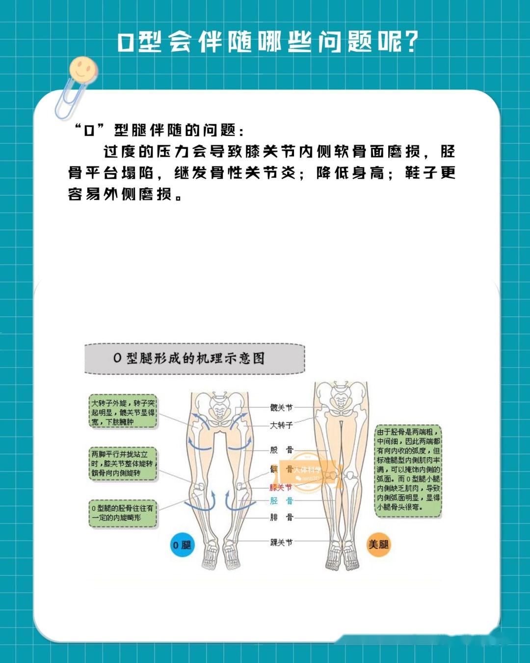 o型腿的原因图片