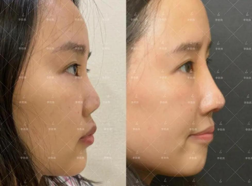 49岁牛莉整容失败,鼻子“牛气冲天”,网友称“毁容式变脸”! - 知乎