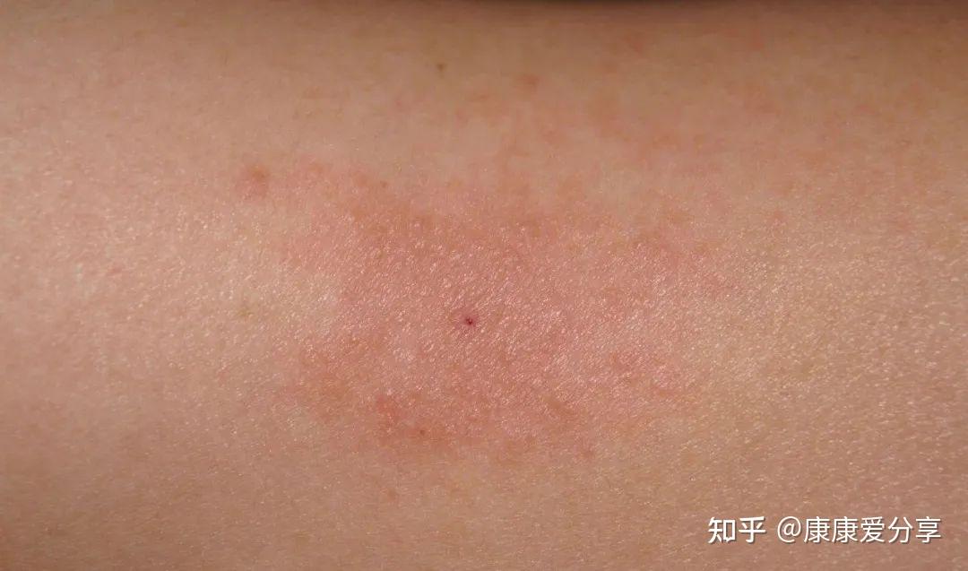 过敏性皮炎的形成,一般会有6大“助攻”,全部知道算你厉害 - 知乎