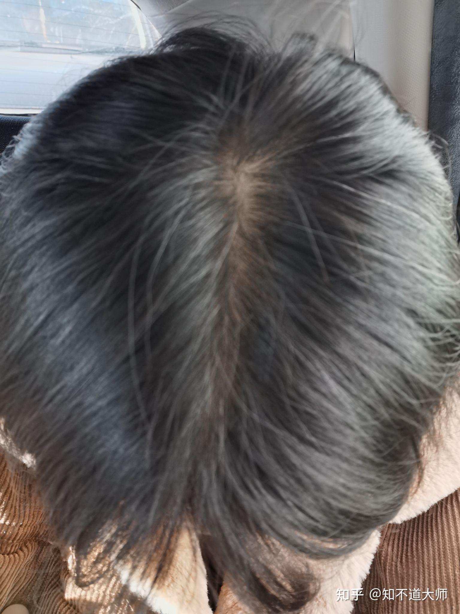 越多故在夏秋高温季节脂溢性脱发就特别严重,在冬春季症状会轻一点,这