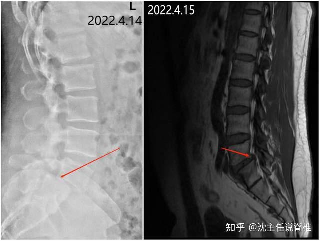 體格檢查:l4,l5棘突壓痛,直腿抬高試驗(-),