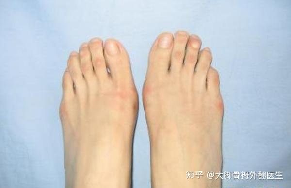轻度大脚骨拇外翻需要治疗吗 知乎