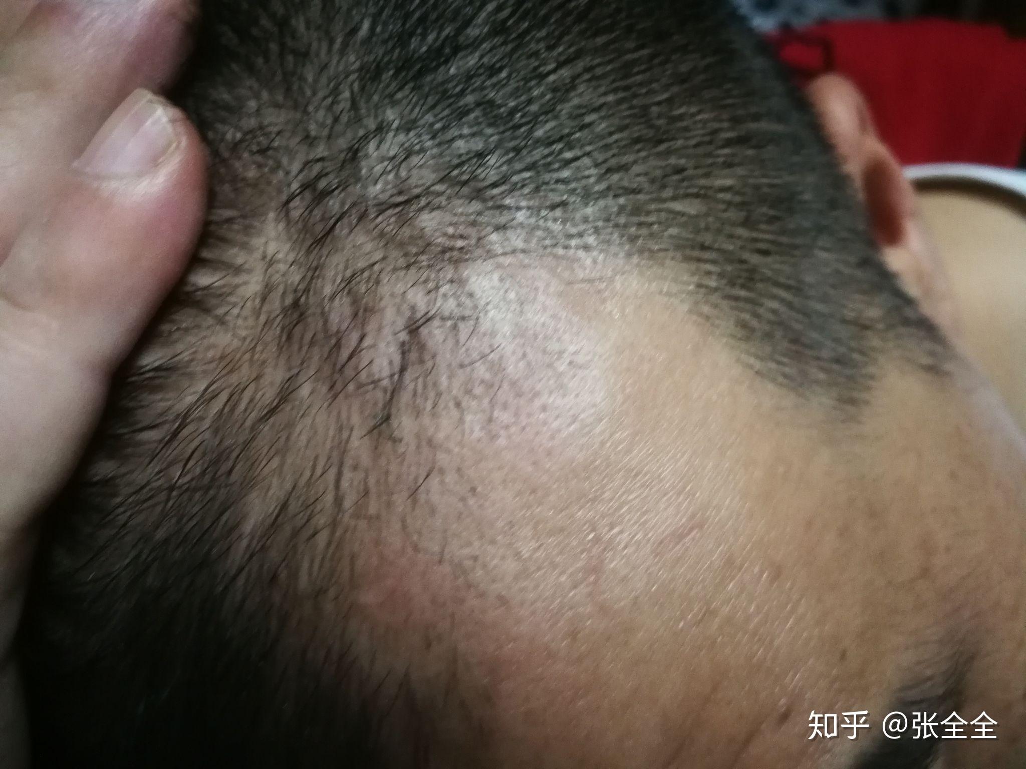 滚针治疗脱发 - 知乎