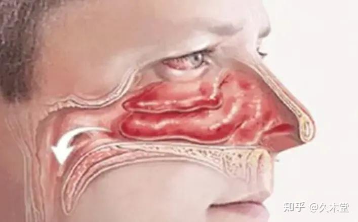 鼻炎难解决警惕药物性鼻炎玖龙台鼻通来舒缓