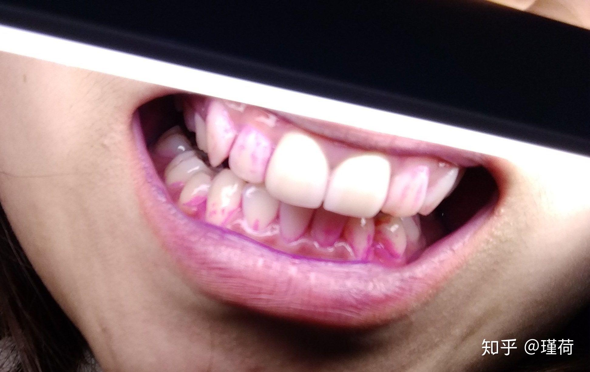 可怕！水女士牙齿上的黑点居然是这个！