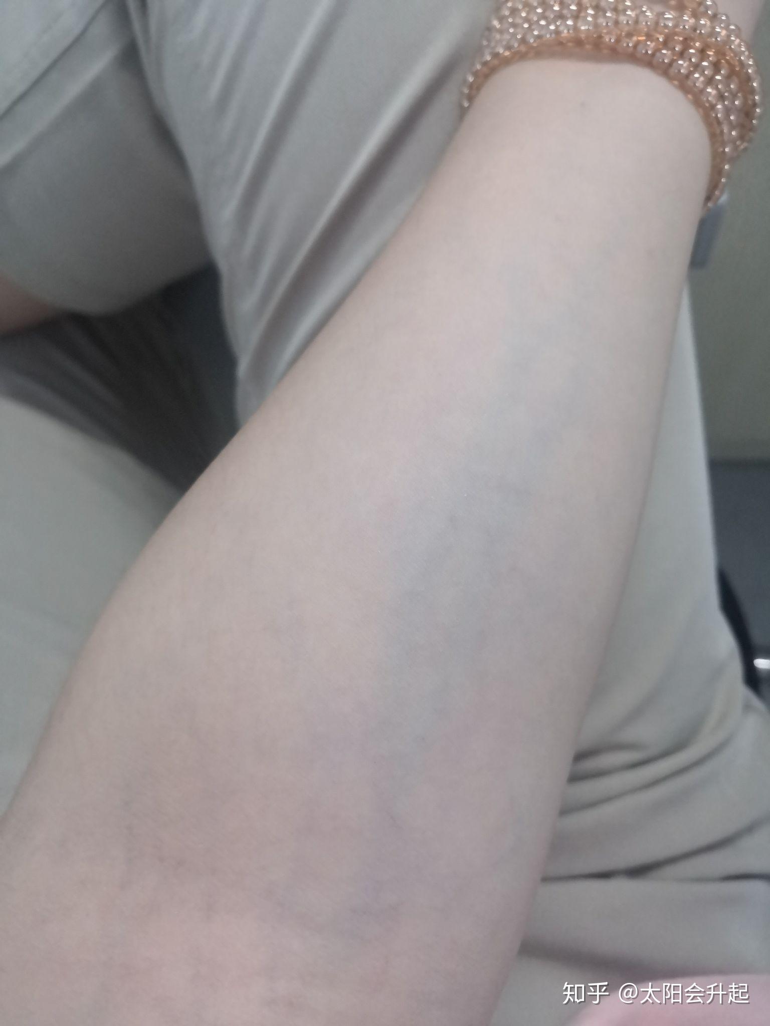 身体血管这么明显有什么影响? - 知乎