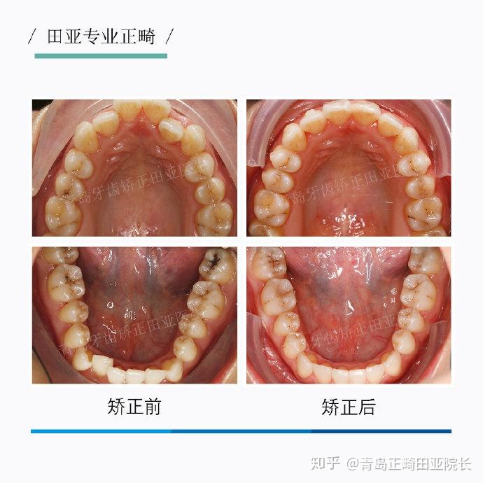 青島牙齒矯正牙列不齊擁擠不拔牙正畸案例