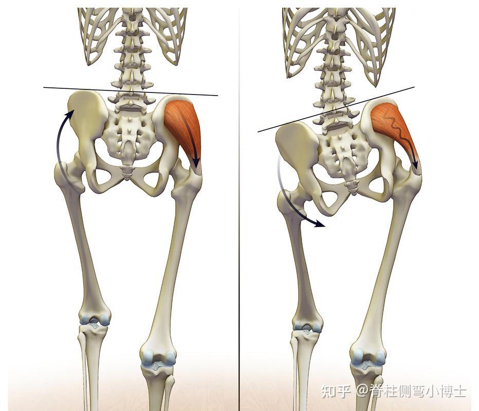 脊柱一侧肌肉凸起图片