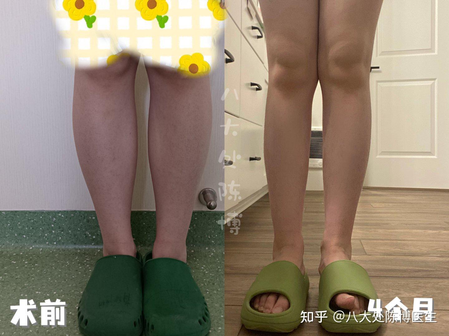大腿吸脂凹陷不平修复两年后的效果分享 - 知乎